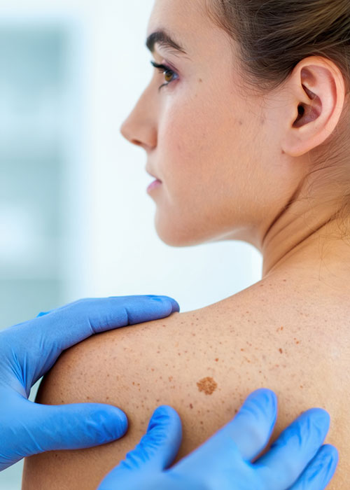 Examen cutané en consultation de médecine générale pour le dépistage des tumeurs cutanées