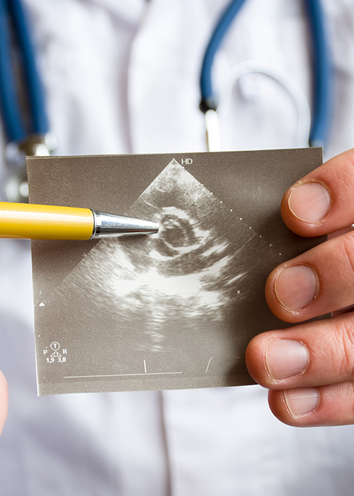 Médecin pointant une anomalie de l'aorte sur une échographie