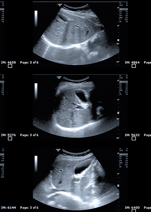 echographie vesicule