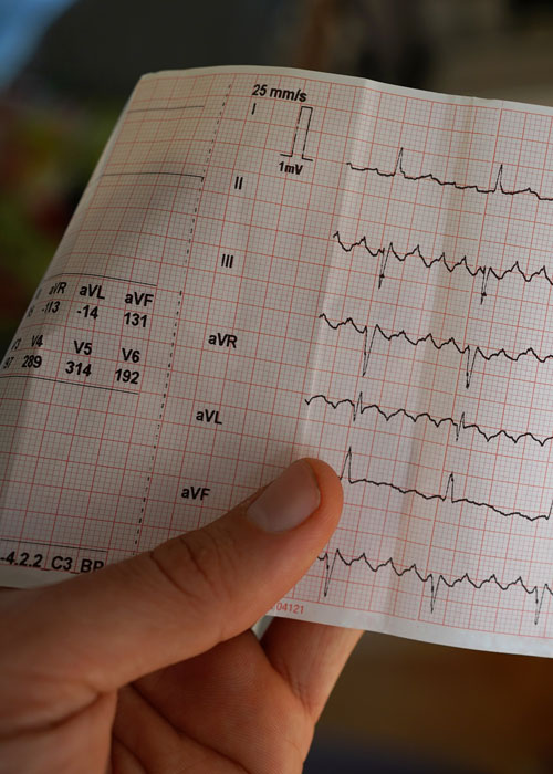 Electrocardiogramme d'une fibrillation atriale