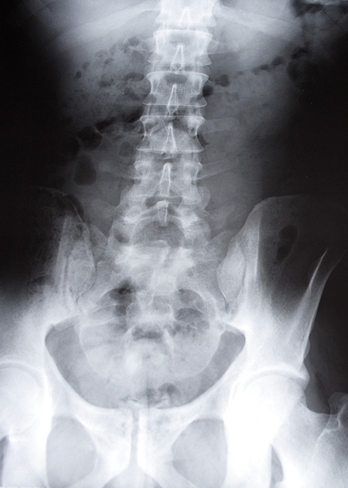 Stéthoscope posé sur une radiographie du rachis