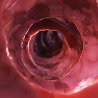 Intérieur d'un intestin atteint de maladie inflammatoire chronique
