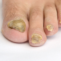 Ongles de pieds atteints d'onychomycose