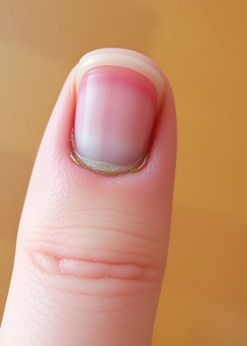 Pathologies des ongles en médecine générale