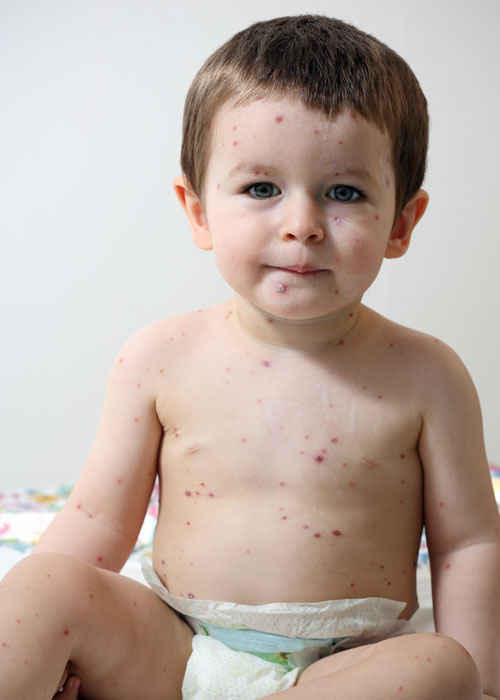 éruptions cutanées enfant