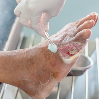 Médecin traitant une plaie chronique sur le pied de son patient