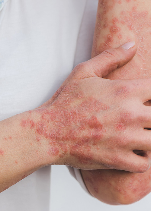 Psoriasis sur les coude d'un adulte