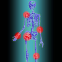Squelette humain avec des articulations touchées par des rhumatismes